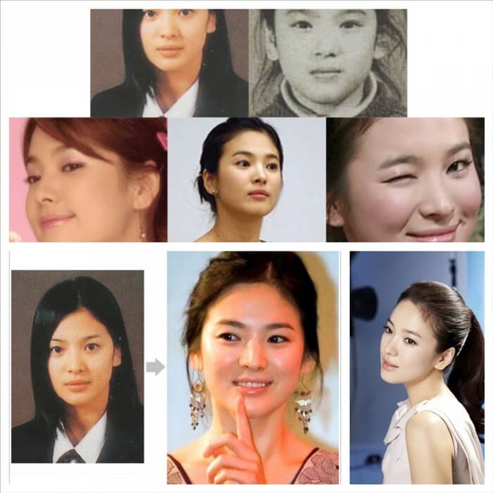song hye kyo no plastic surgery