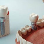 everything to know about dental implant