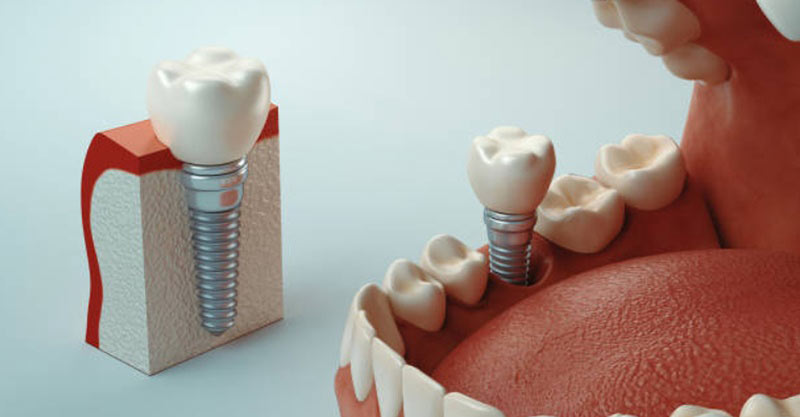 everything to know about dental implant