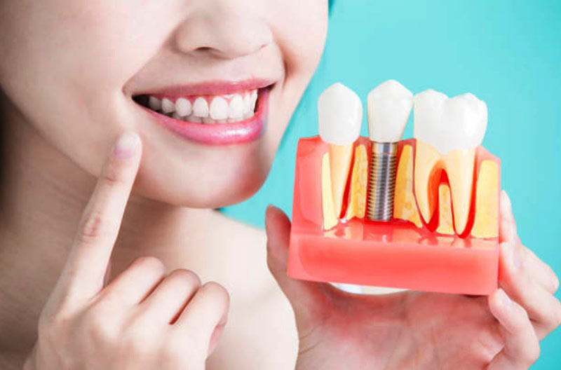 how dental implant works