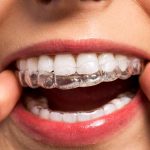 process of dental filling